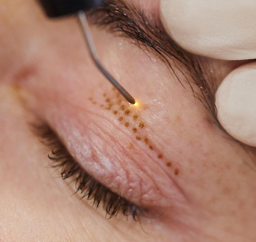 Experience a Non-Surgical Facelift with PlexR